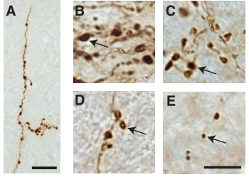 Phát hiện sự di chuyển của protein α-synuclein có liên quan đến cơ chế gây bệnh Parkinson